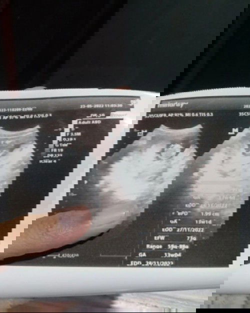 Hai Bun Usia Kehamilanku 15 Minggu Tapi Pas Diusg Kata Dokter Janinnya Terlihat 13 Minggu, Bulan Dep