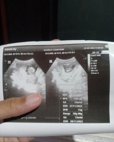 Hai Bun Usia Kehamilanku 15 Minggu Tapi Pas Diusg Kata Dokter Janinnya Terlihat 13 Minggu, Bulan Dep