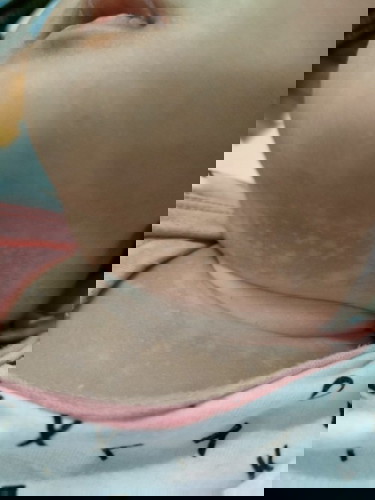 Baby Skin Concern