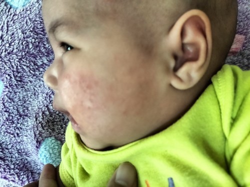 สอบถามค่ะใช้อะไรถึงหายคะ