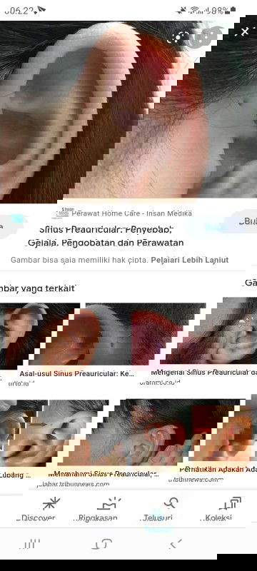 Lubang kecil pada batang telinga anak