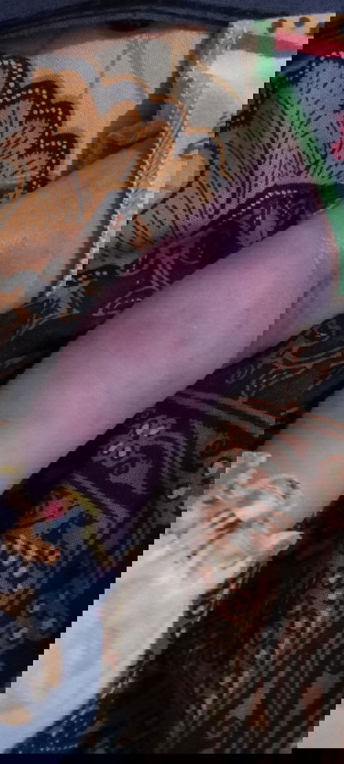 Merah merah pada bayi baru lahir