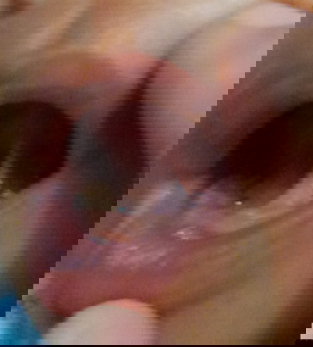 Apakah termasuk tongue tie