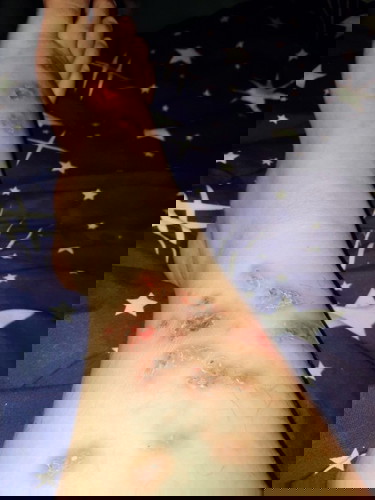 ท้อง 8 เดือนเป็นแผลหนองอักเสบ