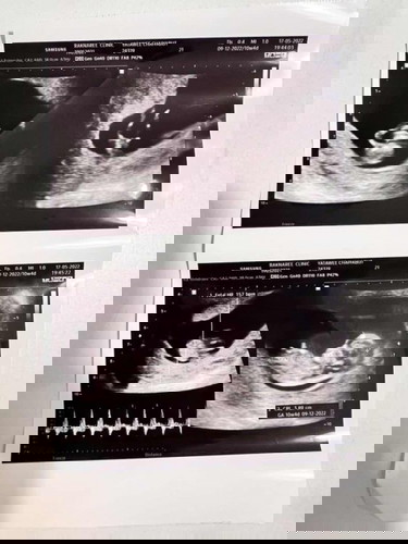 สอบถามคะว่าปกติไหม