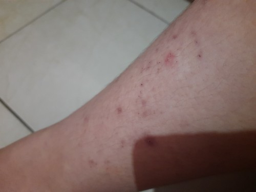 Gatal-gatal saat hamil