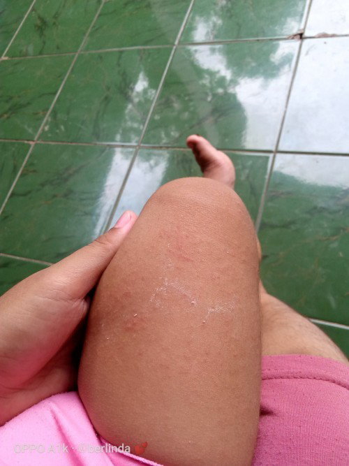 Kulit anak ruam