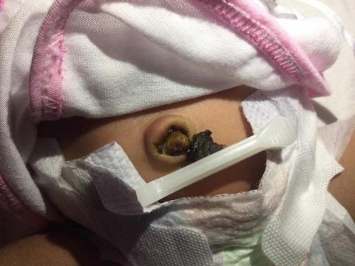 Umbilical cord
