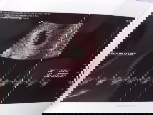 Hasil USG saat usia kehamilan 6 minggu.ini udah terlihat janin nya atau belom ya.