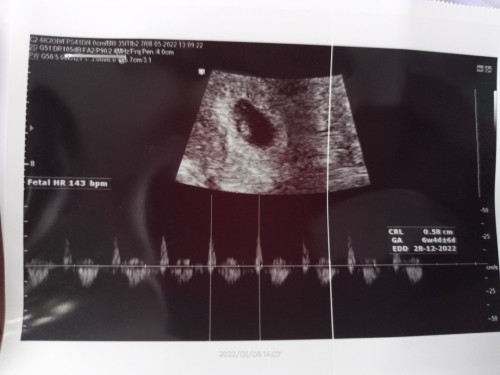 Hasil USG saat usia kehamilan 6 minggu.ini udah terlihat janin nya atau belom ya.