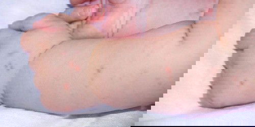 Bintik diwajah dan tangan anak