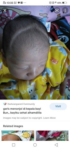 Anak saya umur 2 bulan.
Tiba2 muncul semacam garis timbul di kepala bgn dpan.padhl wkt lhr blm ada