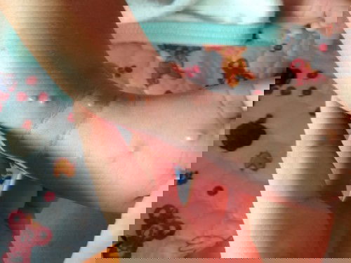 แม่ๆคิดว่าตุ่มแบบนี้เกิดจากอะไรคะ หรือลูกจะเป็นอีสุกอีใส