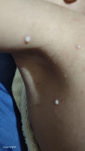 Kaya cacar tapi bukan cacar