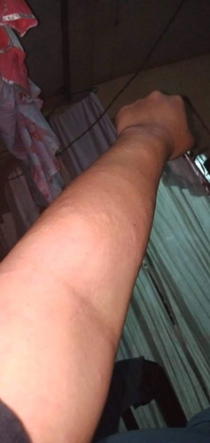 Normal lang po ba magkati kati sa mga binte at braso ang buntis ? Ano po dapat ipahid ?