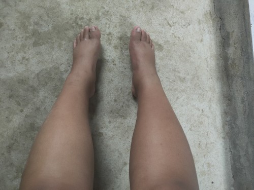 35 w ขาและเท้าบวมหนักมาก ทั้งติ่งขึ้นทั้งคล่ำ