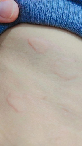Kenapa saat hamil badan bentol dan gatal ?