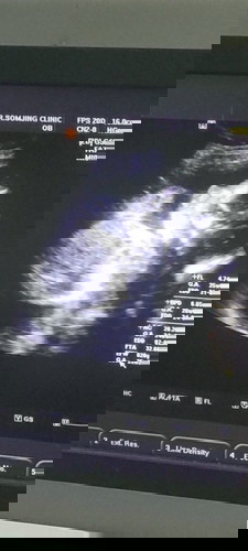 มาอวดภาพอัลตร้าซาวด์ตอน6เดือนกว่ากันค้า