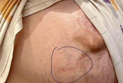 Accidentally knock on to my left tummy