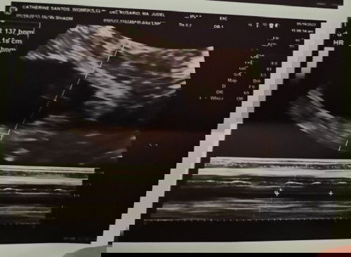 normal lang po ba ang heartbeat ng baby ko im 8weeks pregnant. 137BPM