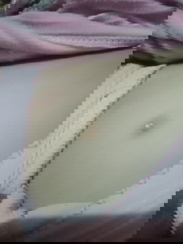 Benjolan putih pada puting anak 2th