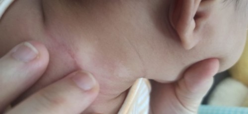 Anyone else experiencing this skin lighter coloured on baby's neck