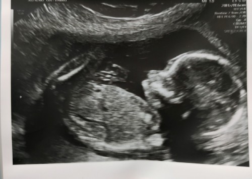 ขอดูรูปอัลตราซาวด์ 19week ของแม่ๆได้มั้ยค่ะ