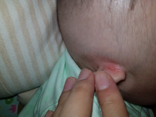 หลังหูลูกเป็นแผล ใช้อะไรทาดี?