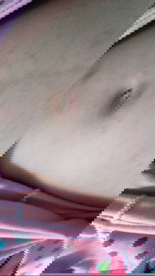 Gatal Hebat Sampai Susah Tidur