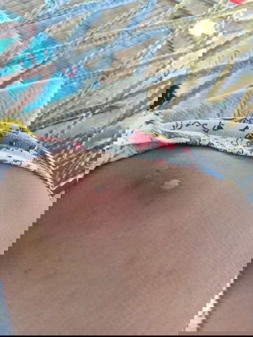 เป็นฝีครั้งแรก2เม็ดเลย
มีแม่ๆคนไหนที่ให้นมน้องแล้วเป็นฝี กินยาตัวไหนได้บ้าง ทรมานสุดๆเลยคะ ตอนนี้ปวด