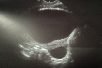 Simple Cyst detected