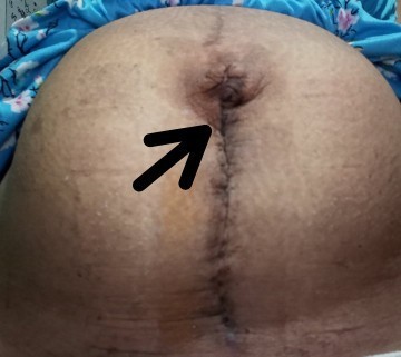 Nagkaroon ng Scab or Kugang ang tawag sa waray.
Ito po yung natutuyong parang balat sa sugat