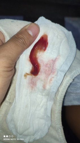 MUCUS PLUG