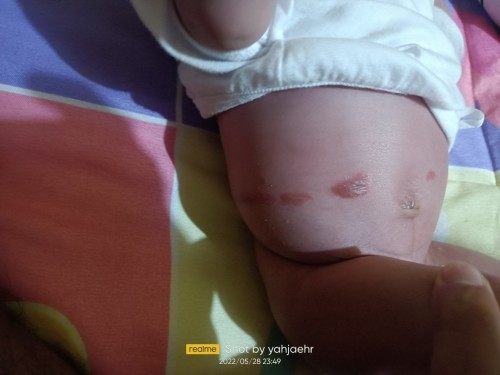 Mga mommies sino kaya may same case ng kay baby? Ano kaya tong tumubo sa knya na parang paso? Tnx.