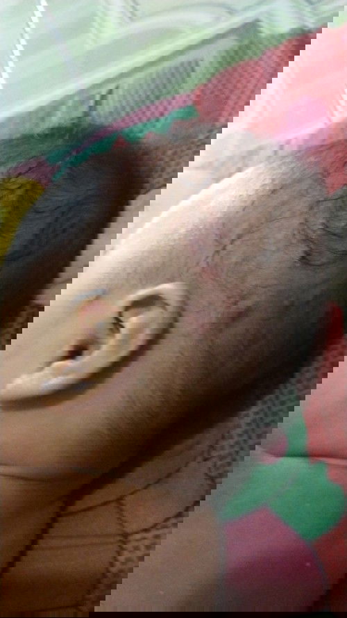 Dikira bisul tapi kok banyak