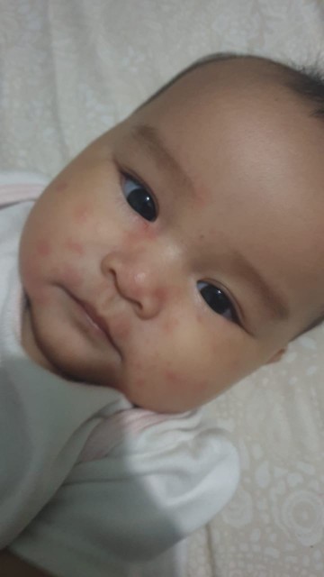Alergi pada bayi