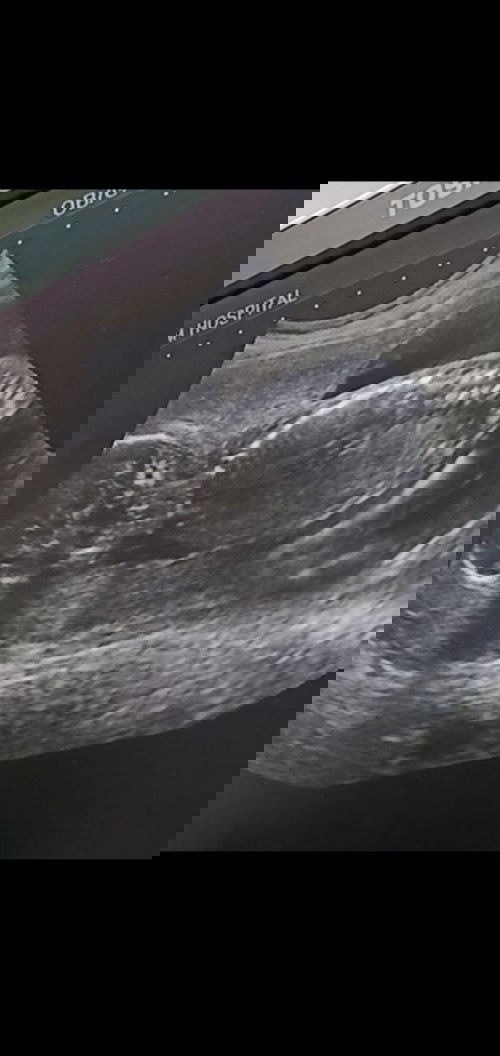 อัลตร้าซาวด์ น้องนอนคว่ำ 20สัปดาห์