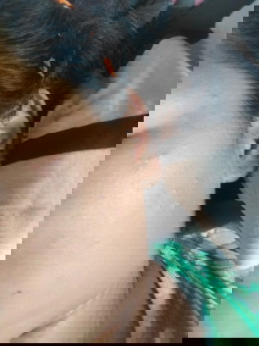 สิวมาเยอะมากจากไม่เคยมี