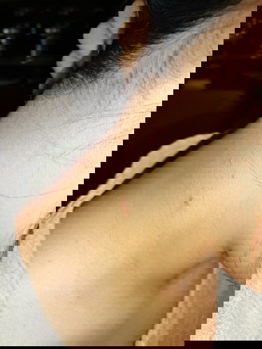 Tumutubo sa leeg at likod