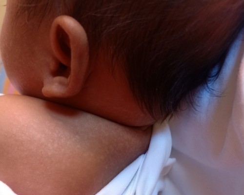 Ano po kaya mainam na gamot sa rashes namuti po sya e ap help naman po kasi parang dumadami op sya e