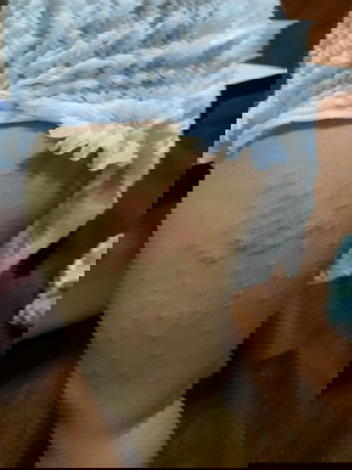 ลูกขึ้นผื่น