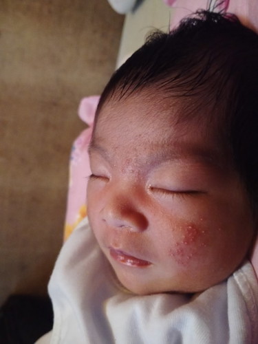 Gamot Baby Acne