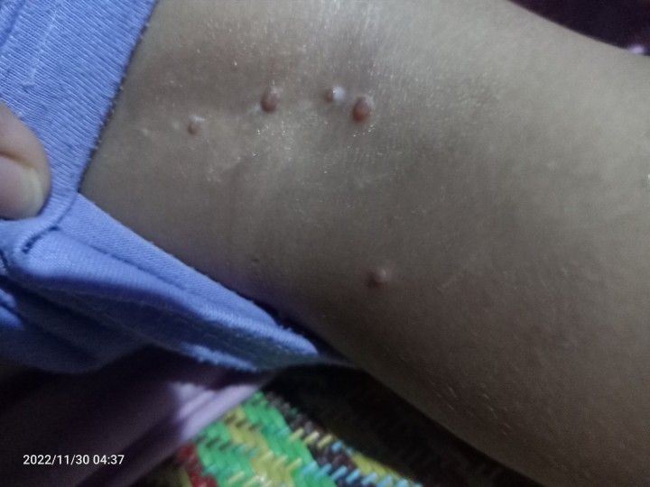 Butlig Butlig na maliliit at kumakalat Pa help po .ano kayang pwden