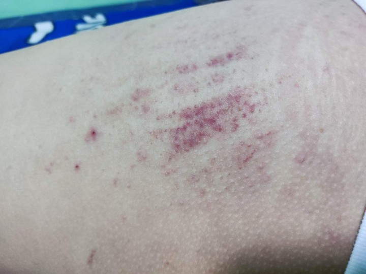 PUPPP Rash Hi mga mommies, ano po pwedeng home remedy for pu