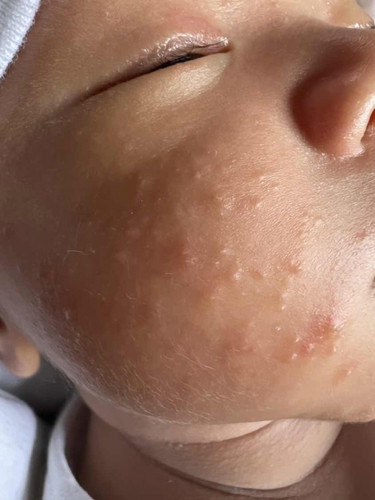Rashes on Face
