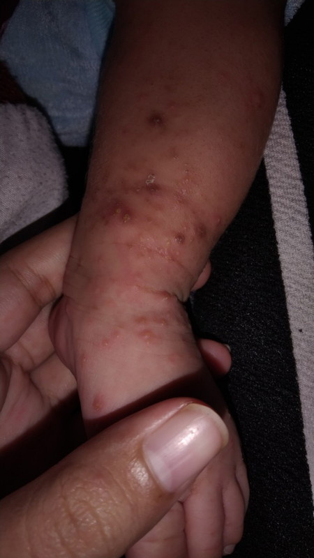 Bayi saya umur 1 bulan apa ini scabies Awalnya merah ruam ki