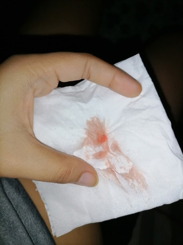 Implantation Bleeding