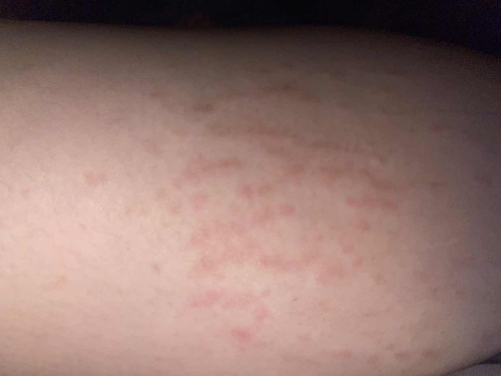 Postpartum Rash Hi mummies, does anyone experience postpartu