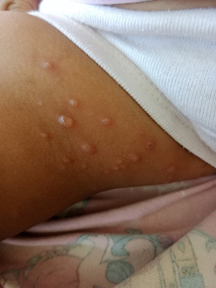 Bulutong tubig