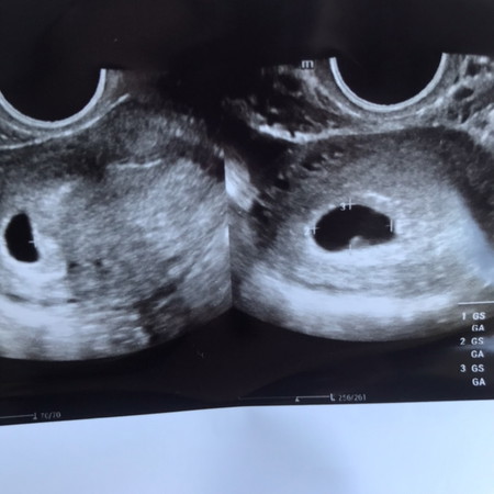 A Blighted Ovum?